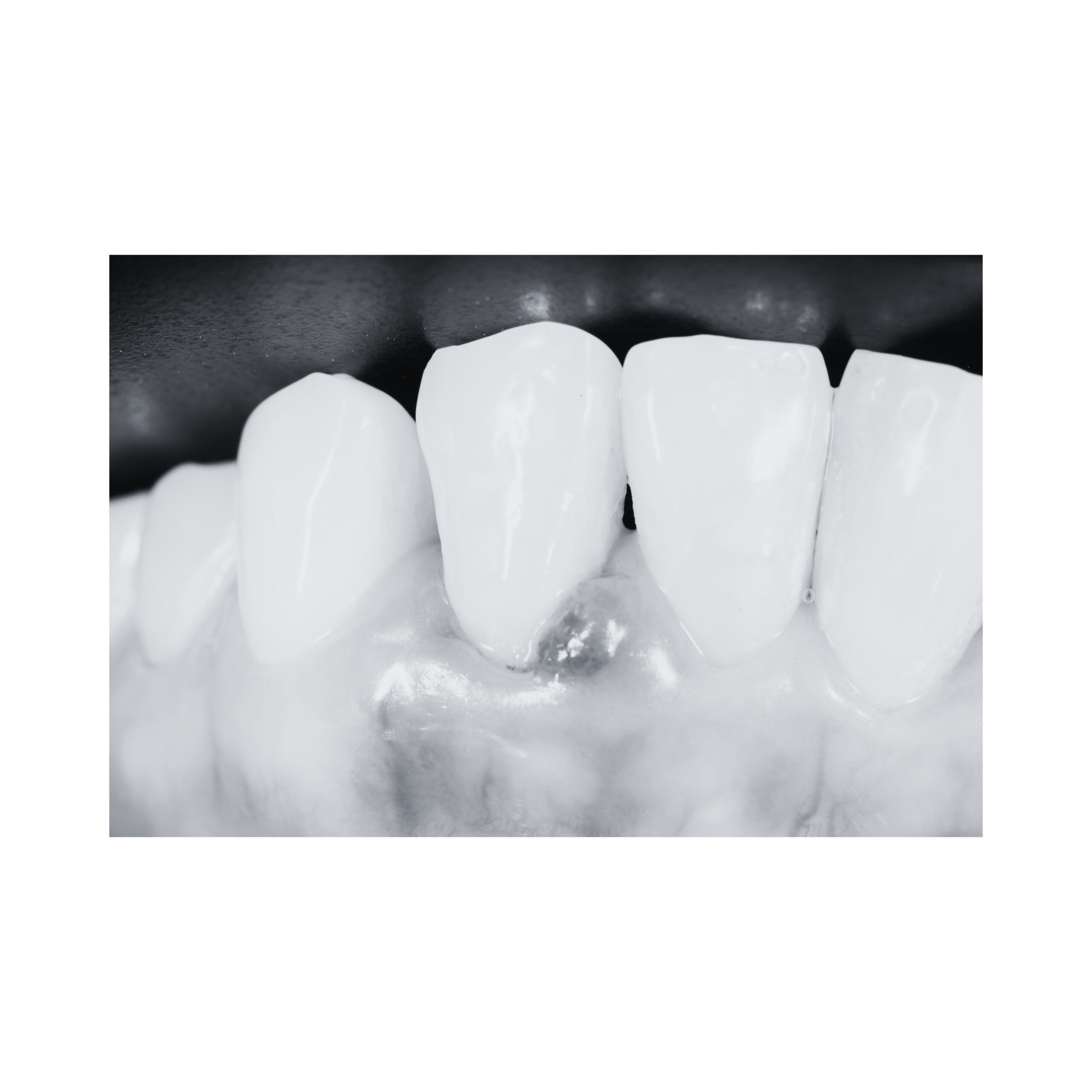 A gingival abscess is a sign you need to have a root canal.